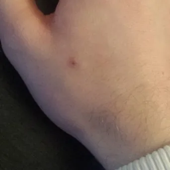 Healing course, the next day: a scab has formed