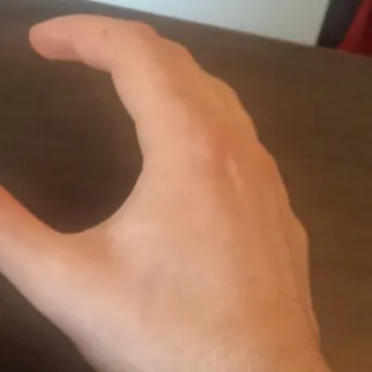 Healing course, 6 to 8 weeks: the mark is almost invisible