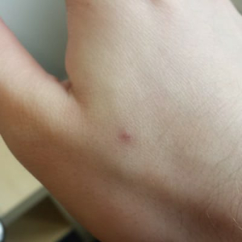 マイクロチップインプラントがインストール直後の手、やく2.5ミリの傷が見える